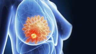 Tomossíntese mamografia 3d proporciona mais precisão na mamografia